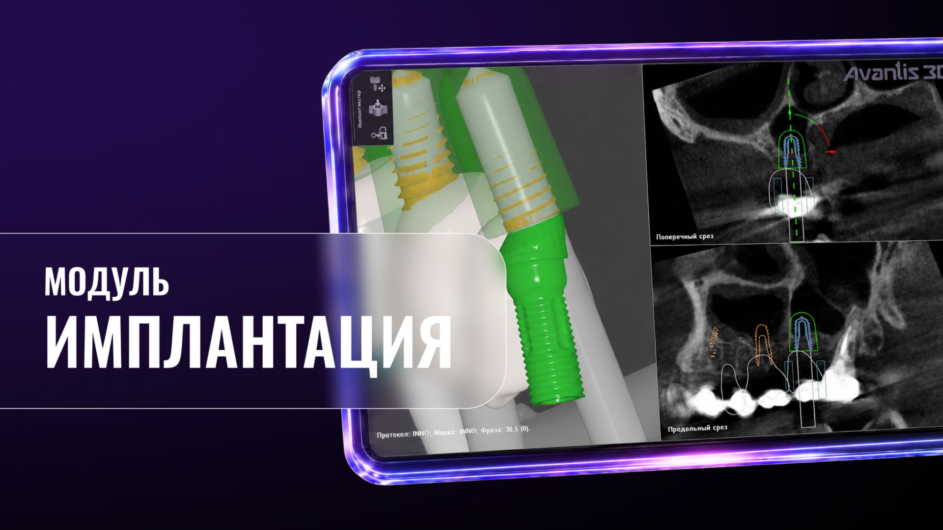 Имплантация (Avantis 3D)