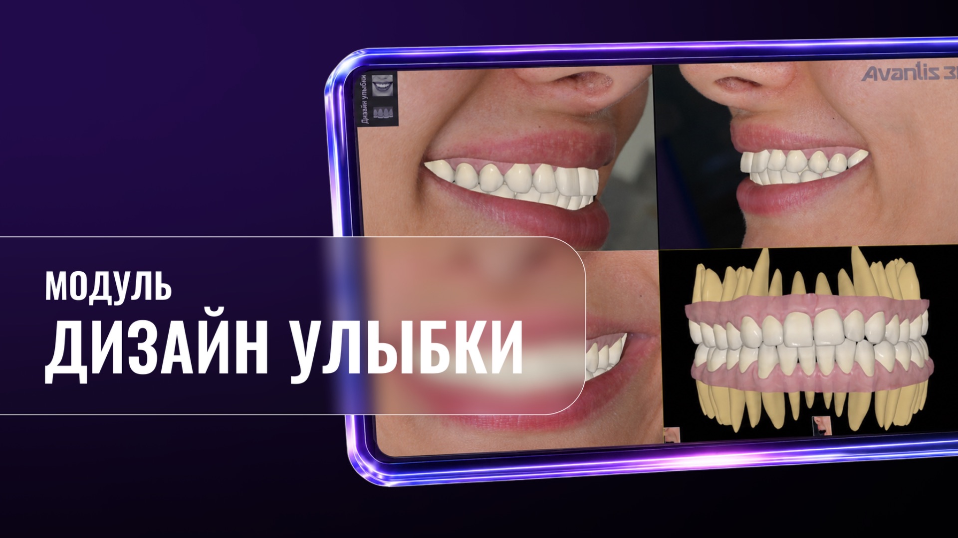 Дизайн улыбки (Avantis 3D)