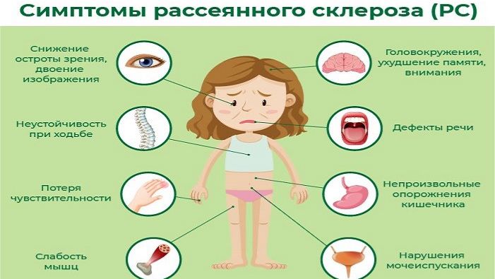 Рассеянный склероз (РС)