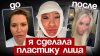 Katya Konasova_Эндоскопия лба и блефаропластика в 39 лет, мо