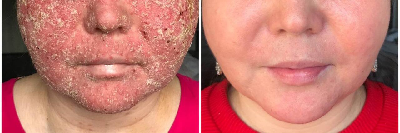 Перевалова Е.Г про лечение розацеа и здоровье кожи