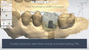 3Shape TRIOS Design Studio - Screw Retained Crown Workflow