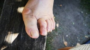 как вылечить ШИШКУ НА БОЛЬШОМ ПАЛЬЦЕ НОГИ Отзыв  MatrixOsteo