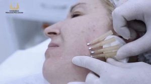 Подтяжка лица мезонитями.