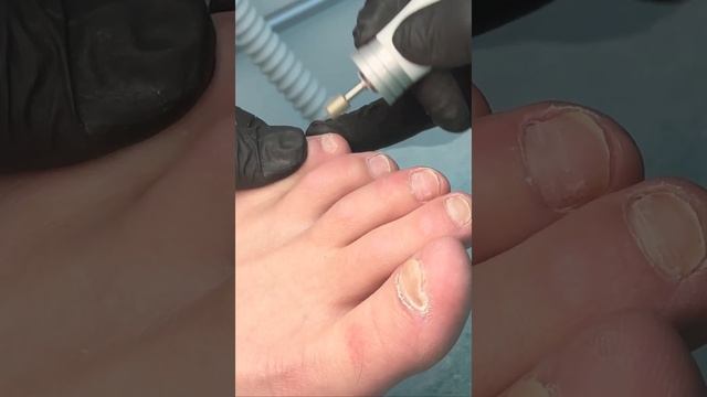 Педикюр медицинский в технике Баумана, подолог смотреть онлайн