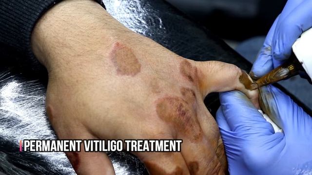 Permanent Makeup for Vitiligo - Vitiligo Cover Up Tattoo - Micro-pigmentation for Vitiligo смотреть онлайн