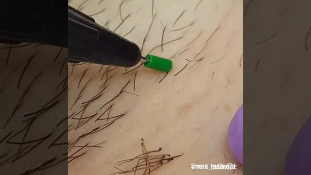 Электроэпиляция смотреть онлайн