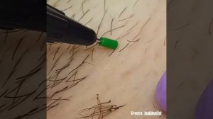 Электроэпиляция