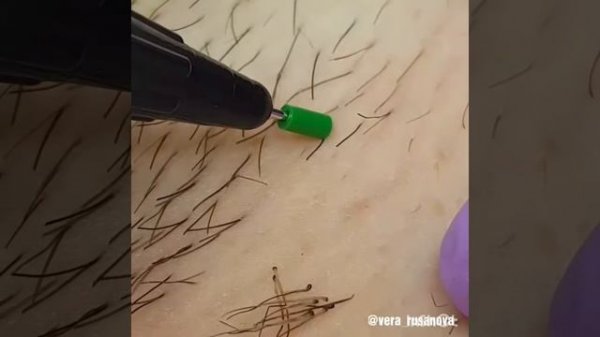 Электроэпиляция