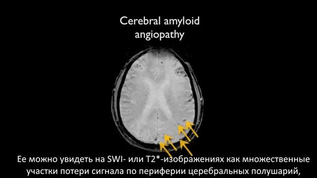 Инсульт (Stroke Series) - Лобарные кровоизлияния. смотреть онлайн