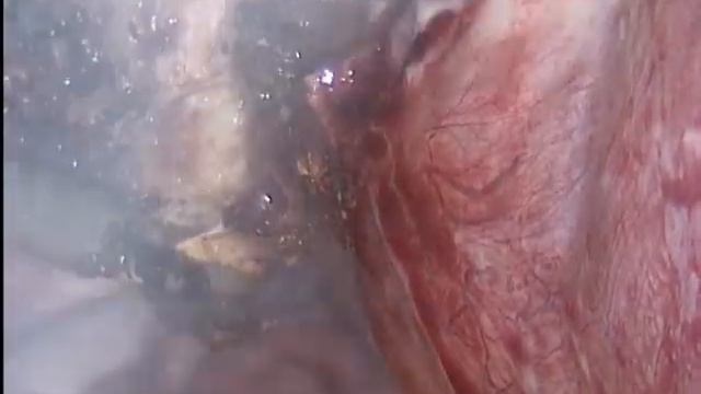 Лапароскопия. Экстирпация матки.