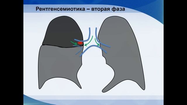 Центральный рак легкого - Рентген смотреть онлайн