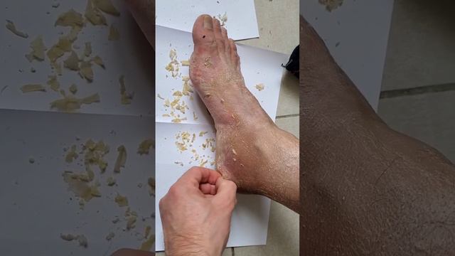 как выглядит нога после гипса #перелом #переломноги #ногавгипсе