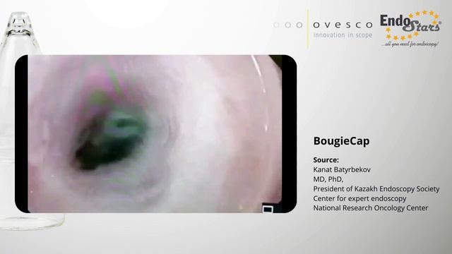 Клинический случай использования BougieCap  для бужирования стриктур пищевода