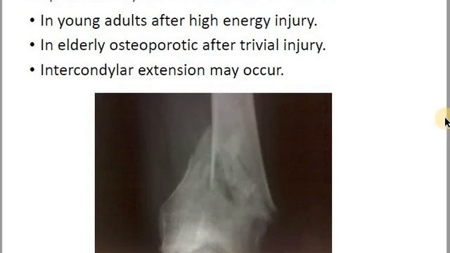 كسور د.مثنى femur shaft and patella смотреть онлайн