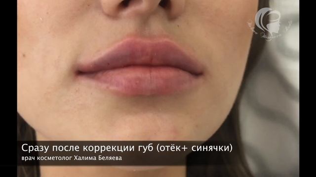 Губы СРАЗУ ПОСЛЕ увеличения смотреть онлайн