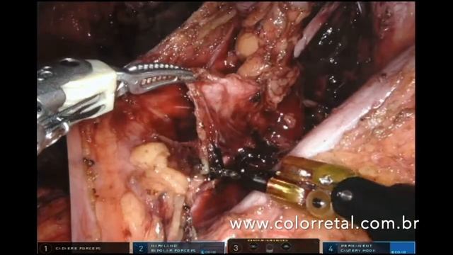 Robotic pelvic lateral lymph node dissection for rectal cancer смотреть онлайн
