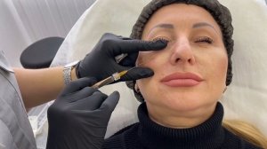 Коррекция носослезной борозды