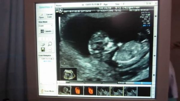 Узи 3D - 10 неделя беременности.