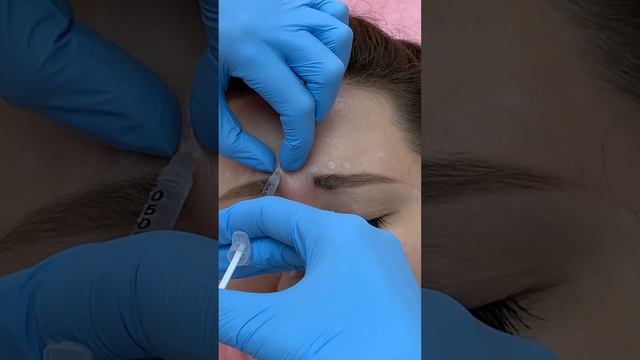 Убираем мимические морщины препаратом на основе ботулотоксина. смотреть онлайн