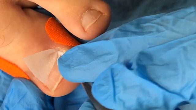 Вросший ноготь????❌ • Острый шип?? смотреть онлайн