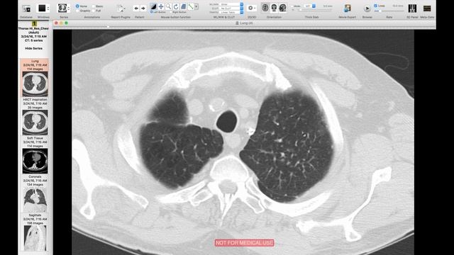 Algorithmic Approach to Multiple Lung Nodules смотреть онлайн