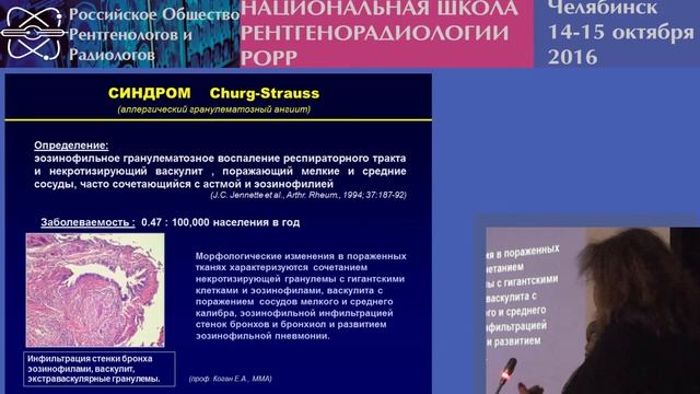 И.А. Соколина - Легочные васкулиты