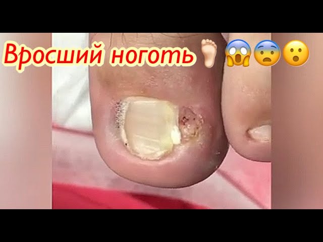 Вросший ноготь??? смотреть онлайн