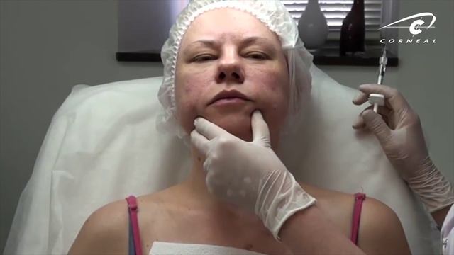 Поднимаем уголки губ, коррекция нижней трети лица смотреть онлайн