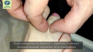 Самостоятельная диагностика лимфедемы: признаки начала заболевания