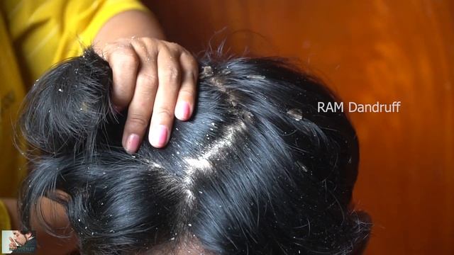 Psoriasis treatment, Dandruff Removal, Itchy Scratching, Huge Flakes #295 смотреть онлайн