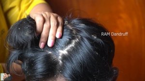 Psoriasis treatment, Dandruff Removal, Itchy Scratching, Huge Flakes #295