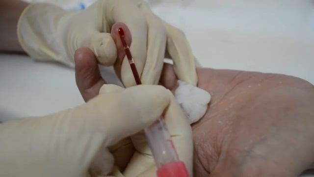 Скорость оседания эритроцитов (СОЭ) смотреть онлайн