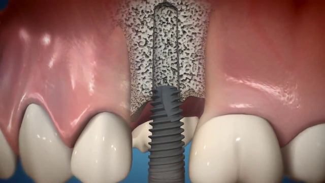 MIS Implants C1 Implant Movie in 3D animation смотреть онлайн