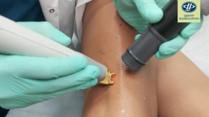 Как проходит удаление сосудистых звездочек на ногах лазером в Центре Флебологии