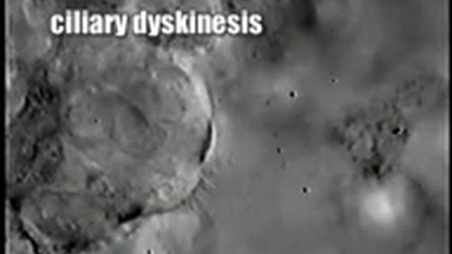 Normal Cilia vs. PCD Cilia смотреть онлайн