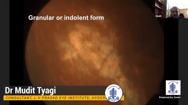 Walk in Uvea Patient in your OPD - Pattern Recognition in Retinitis - Dr Mudit Tyagi смотреть онлайн