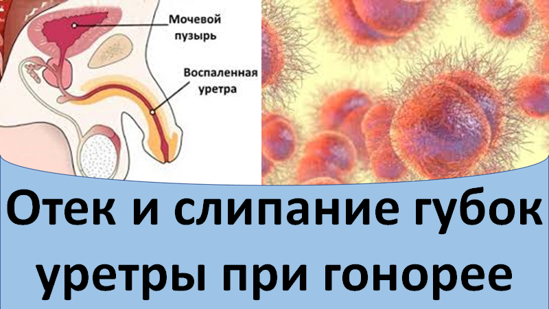 Отек и слипание губок уретры при гонорее смотреть онлайн