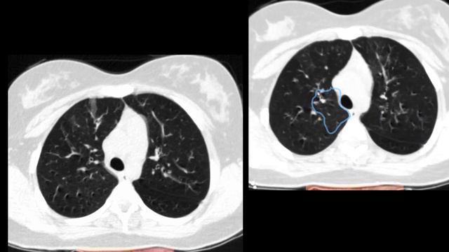 Covid19 CT Chest Findings. смотреть онлайн