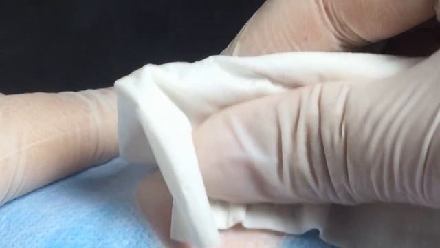 BEST Pimple Popping // Big Cystic Acne Blackheads // Whiteheads Removal / Squeezing Pimples / Vy#41