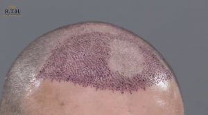 Берегите голову! Или что делать после пересадки волос.