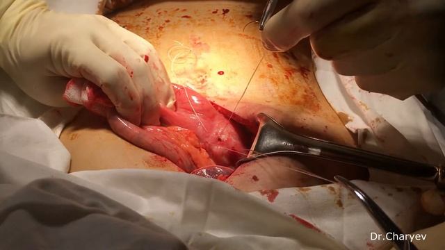 Прободная язва желудка смотреть онлайн