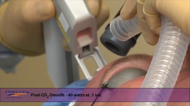 FPC Co2 Laser Skin Resurfacing смотреть онлайн