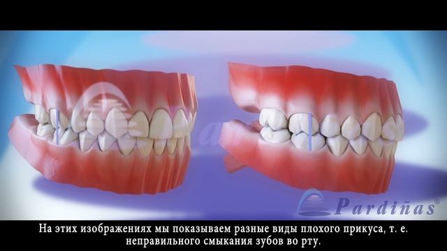 Неправильный прикус - Виды патологических прикусов © смотреть онлайн
