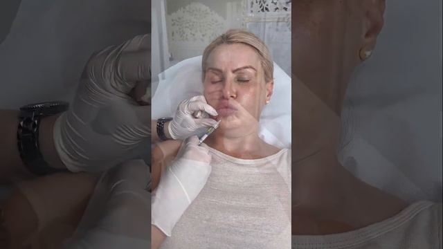 ФИЛЛЕР В МОРЩИНЫ ВОКРУГ ГУБ- КИСЕТНЫЕ МОРЩИНЫ 50+, КРАСОТА, BEAUTY OVER 50 years, НЕ МАССАЖ!