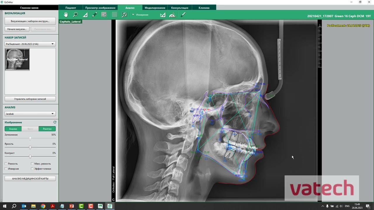 Демонстрация программы ezOrtho смотреть онлайн