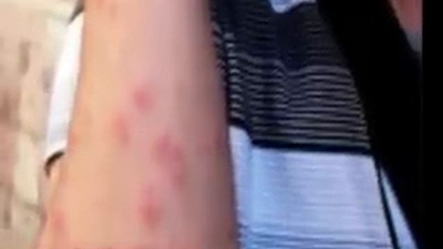 Bed Bug Bites Brooklyn New York смотреть онлайн
