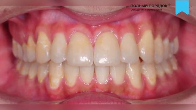 Результаты лечения скученности без удаления металлическими брекетами Damon Q смотреть онлайн