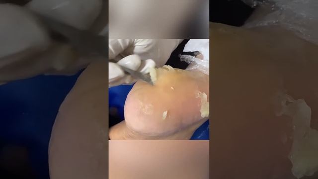 Препаратный педикюр смотреть онлайн