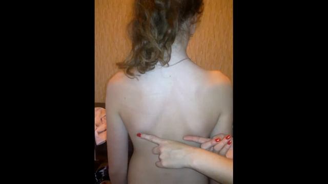 Сколіоз лікування. Порушення постави - корекція після першого сеансу. "Cherednyk Medical" смотреть онлайн